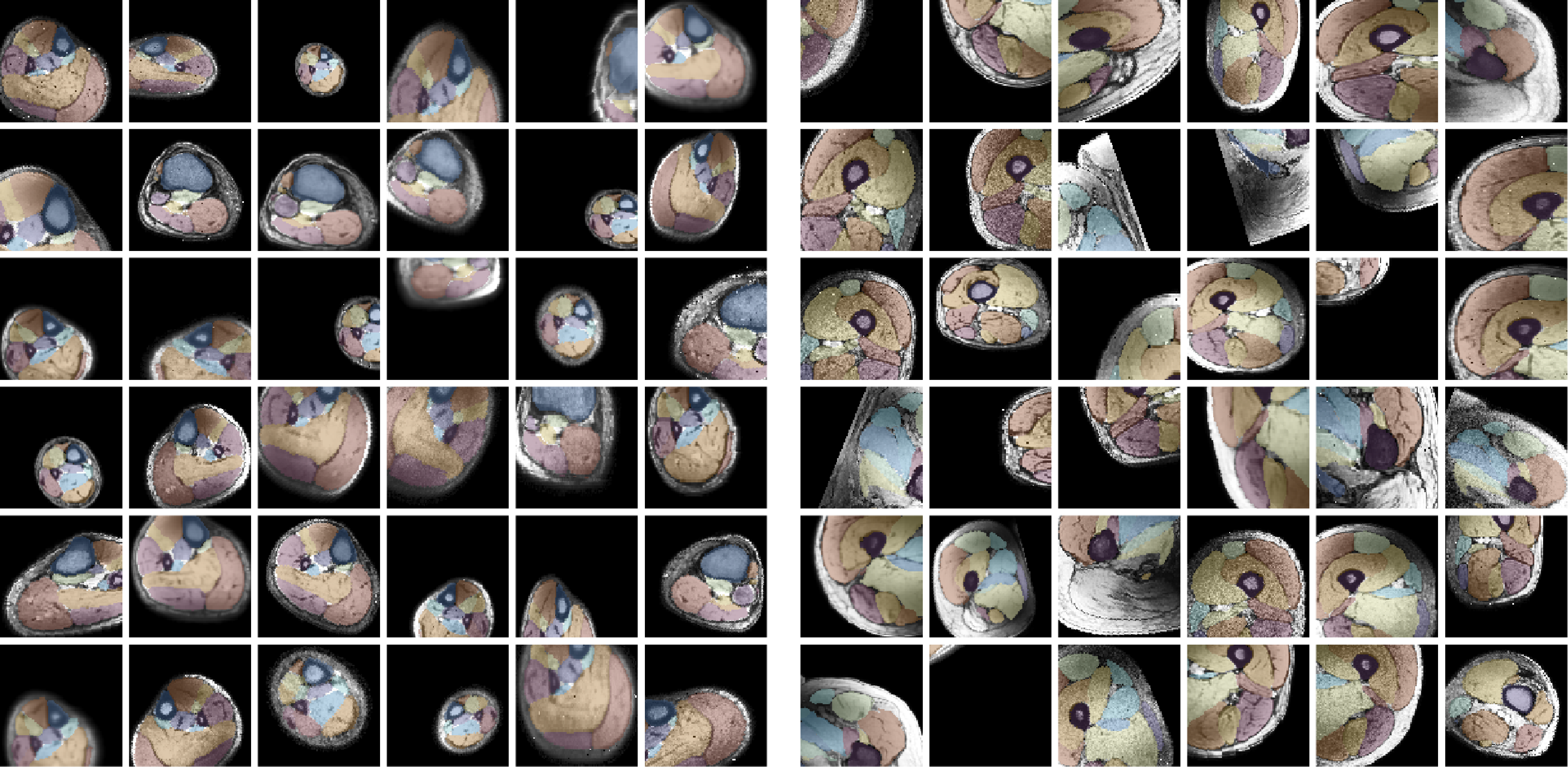 Example of data augmentation used for training the upper and lower leg segmentation UNET. Example of data augmentation used for training the upper and lower leg segmentation UNET.